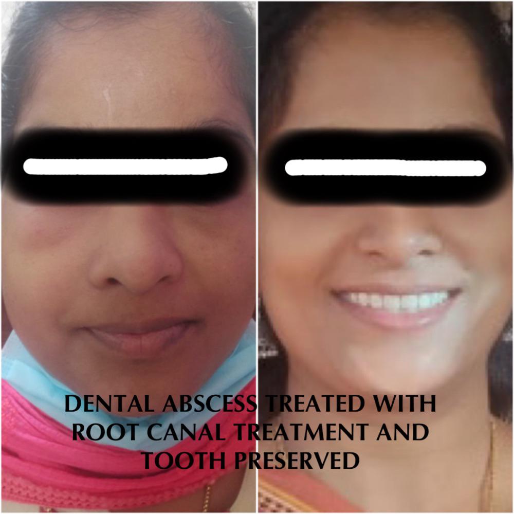 Dental Abscess to Tooth Preserved
