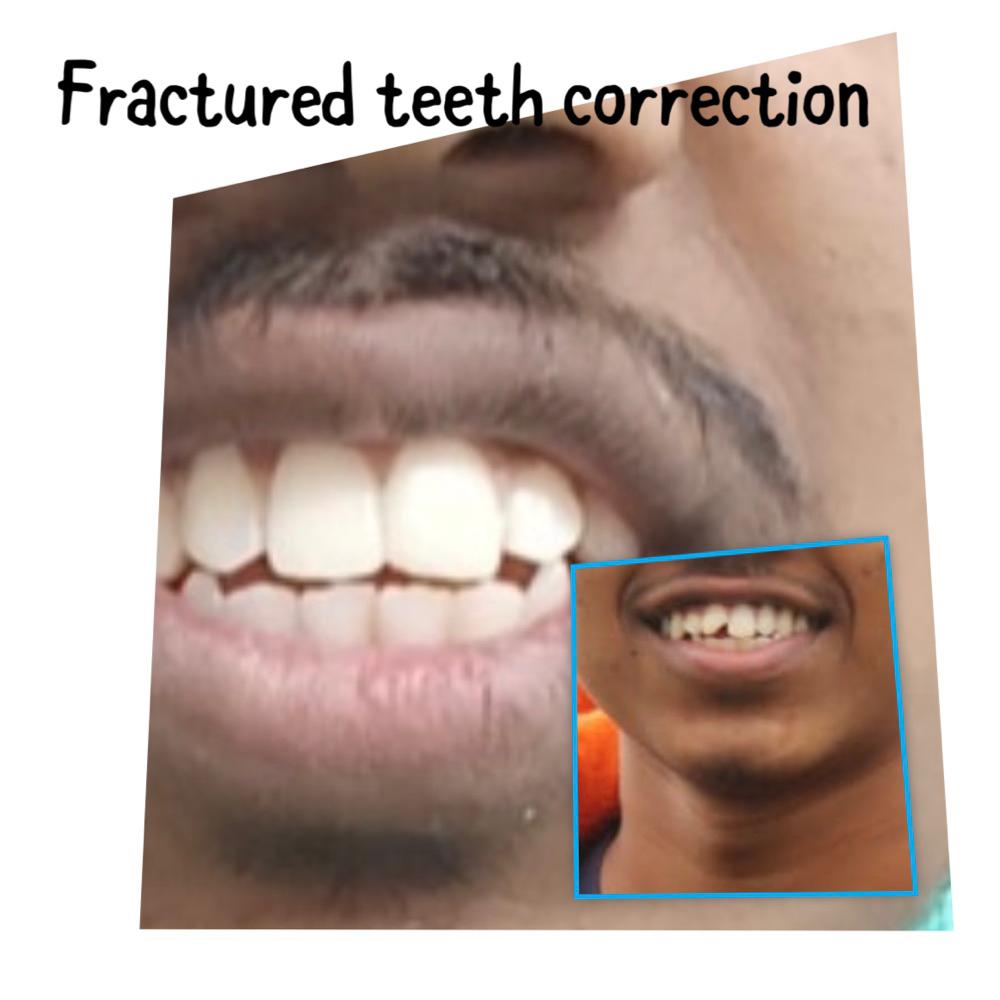Fractured Teeth Correction