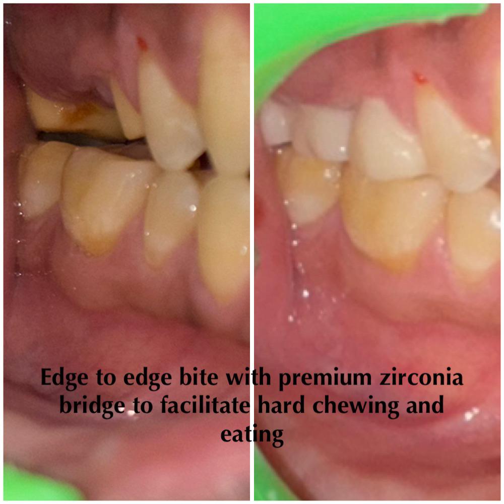 Premium Zirconia Bridge