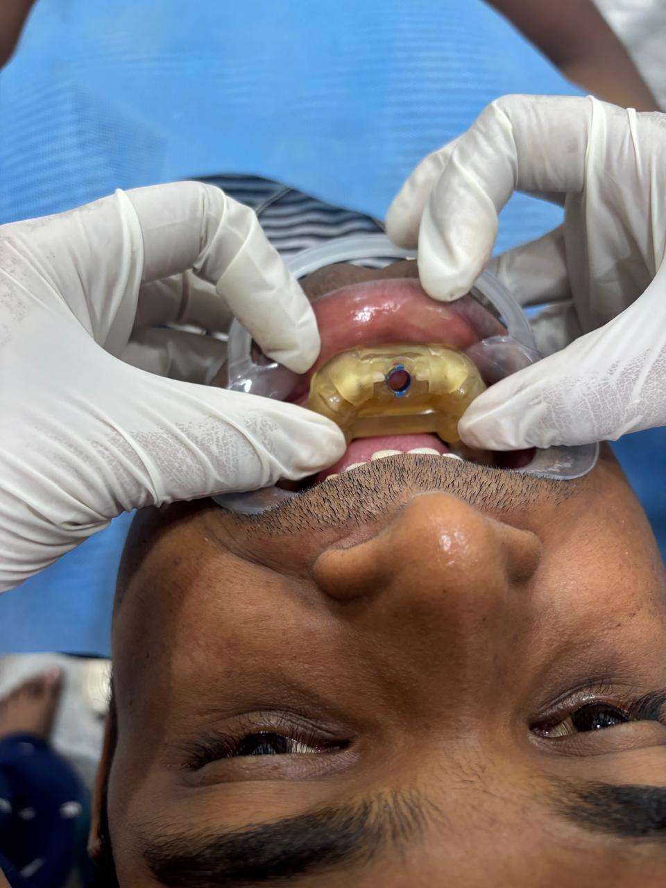Guided Implant